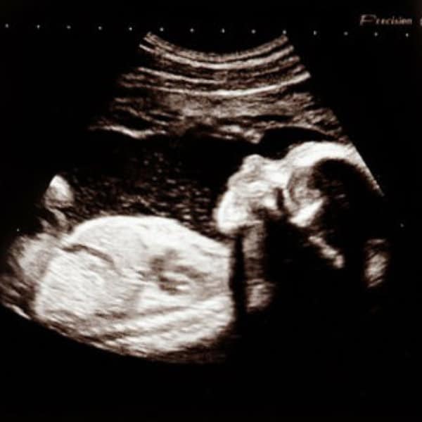 graviditets uge 12, graviditets uge 12+, nakkefoldsscanning