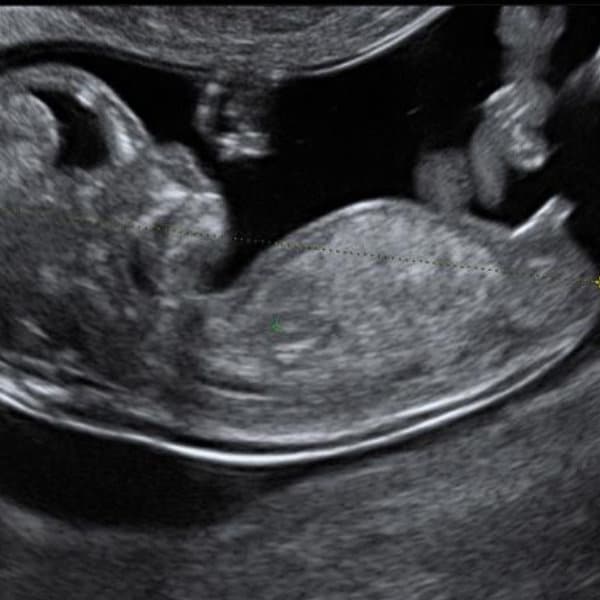 graviditets uge 14+, graviditets uge 14, se kønnet